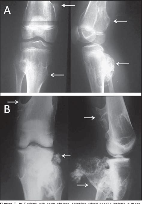 Figure 3 From Knee Bone Tumors Findings On Conventional Radiology
