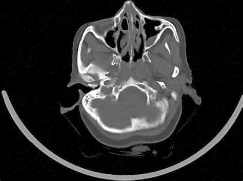 Axial Computed Tomography Scan Of Paranasal Sinuses Showing Bilateral