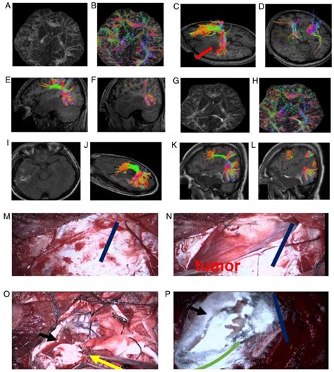 Application Of Diffusion Tensor Tractography In The Surgical Treatment