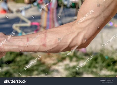 Swollen Veins Scars On Arm Stock Photo 1140808298 Shutterstock