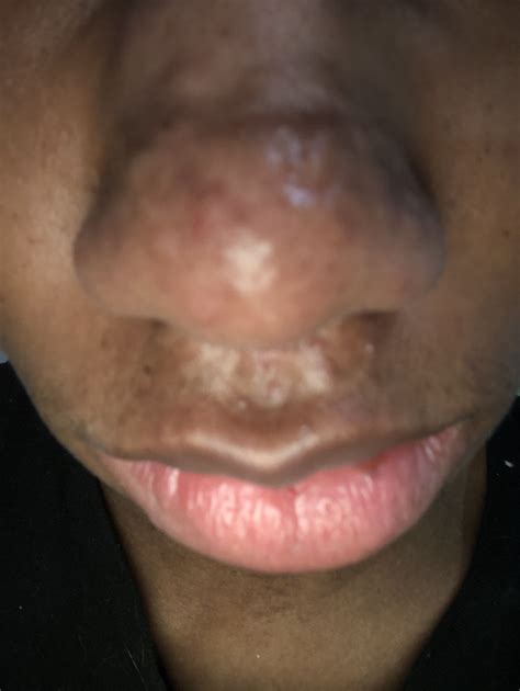 Raised Hypertrophic Nose Acne Scars Help Me Plzzz Hypertrophic