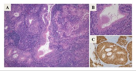 Figure 1 From Ciliated Squamous Cell Carcinoma Of The Tonsil Semantic