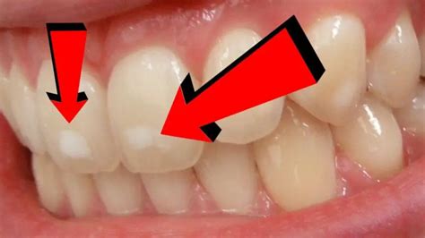 What Causes White Spots On Teeth How To Cure It Home Remedies