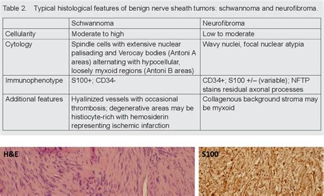 Figure 1 From Tumors Displaying Hybrid Schwannoma And Neurofibroma