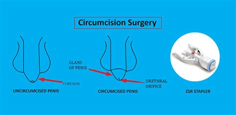 Fertigkeit Anzai Angeben Laser Circumcision Results Genau Bewegung Fragebogen