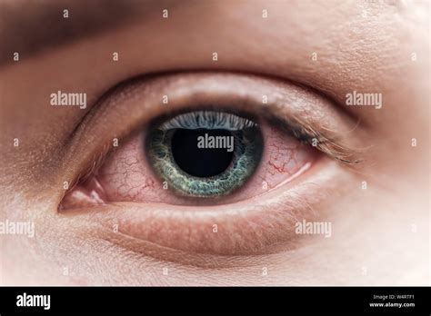 Close Up View Of Human Eye With Red Capillaries Stock Photo Alamy