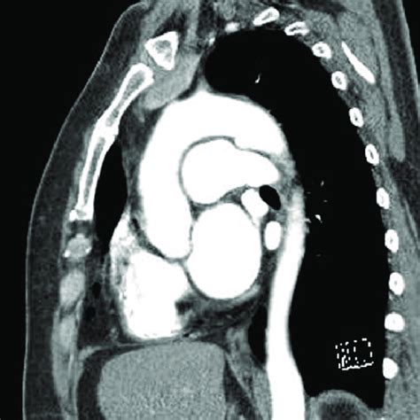 Preoperative Three Dimensional Computed Tomography Image Of The Aorta