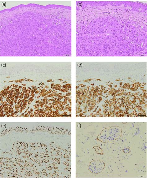 Histopathologic Findings Of Skin Biopsy A Tumor Cells Proliferating