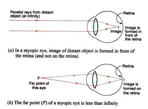 Defects Of Vision And Their Correction Class 10 The Human Eyes And