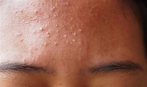 What Does Fungal Acne Look Like The Wiire