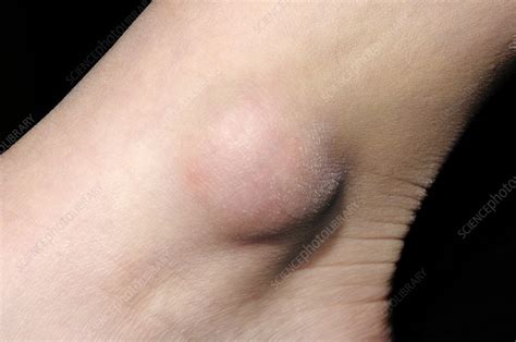 Bursitis Of The Ankle Stock Image C0024860 Science Photo Library