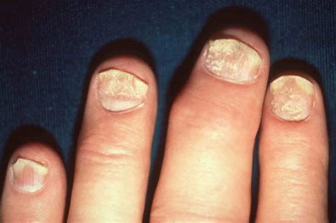 Can Nail Psoriasis Be Cured 4 Best Nail Psoriasis Treatment Options