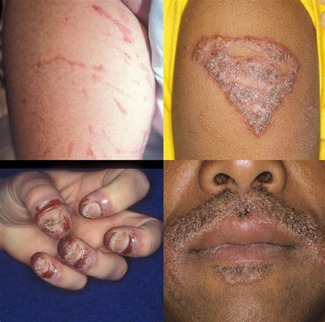 What Is An Allergic Skin Reaction Minnesota Spokesman Recorder