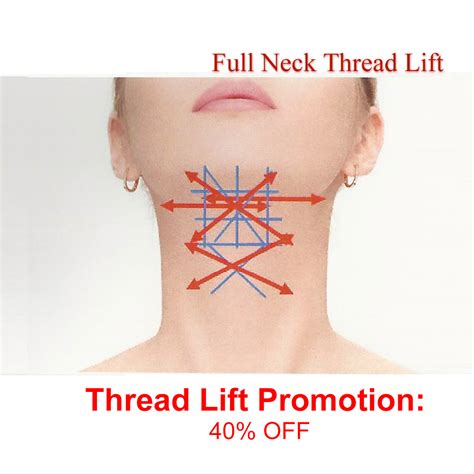 9 Thread Neck Lift Lift Thread Neck Skin Incisions Aging Tightening