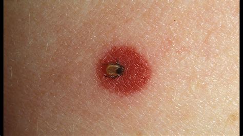 How To Spot Lyme Disease Webmd Youtube