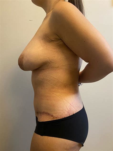 Real Patient Case 2699 Ingram Cosmetic Surgery