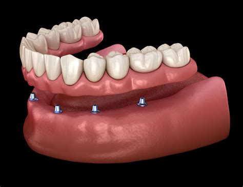Woodland Hills Dentist Offers Implant Dentures In A Day Woodland Hills Ca