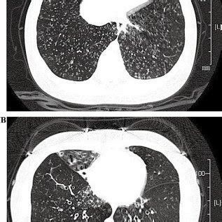 Pathology Change Of Transbronchial Lung Biopsy Hematoxylin And Eosin