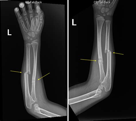 Greenstick Fractures Of The Mid Radial And Ulnar Diaphysis With Volar
