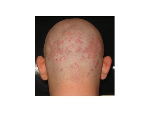 Red Bumps On Scalp Small Itchy Bumps On Scalp Painful Itchy Bumps On