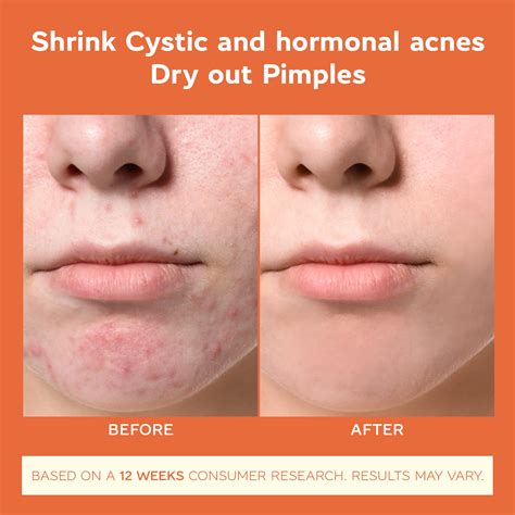 Buy Cystic Hormonal And Severe Acne Treatment Cream For Teens And Adults Acne Treatment With