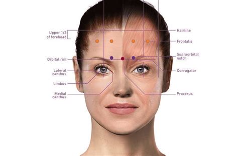 Botox Migraine Injection Sites Diagram My Xxx Hot Girl