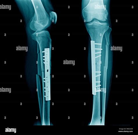 Fracture Of Tibia And Fibula High Resolution Stock Photography And