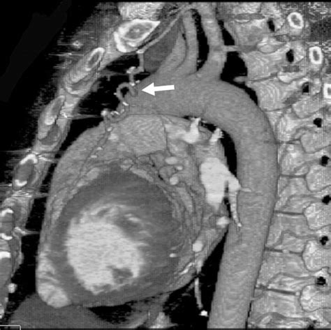 Multisection Ct Evaluation Of The Reoperative Cardiac Surgery Patient