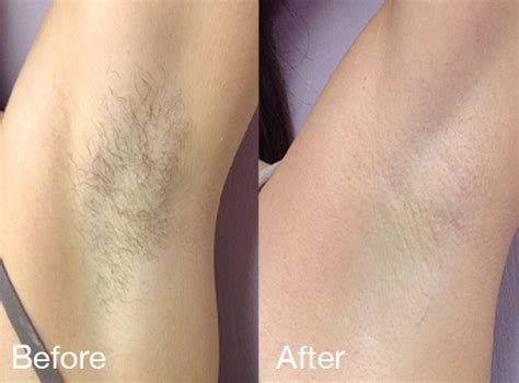 How much does laser hair removal cost for eyebrows. Laser Hair Removal | Horizon Medical Spa- High Point ...