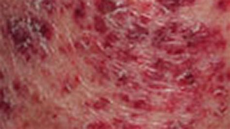Anemia Rash Causes Pictures And Treatment