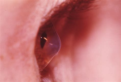 Keratoconus Hereditary Ocular Diseases