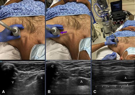 Ultrasound Guided Retroclavicular Approach To The Infraclavicular