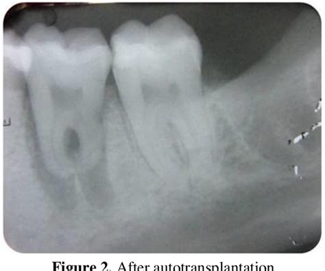Figure 2 From Autotransplantation Of A Mature Mandibular Third Molar To