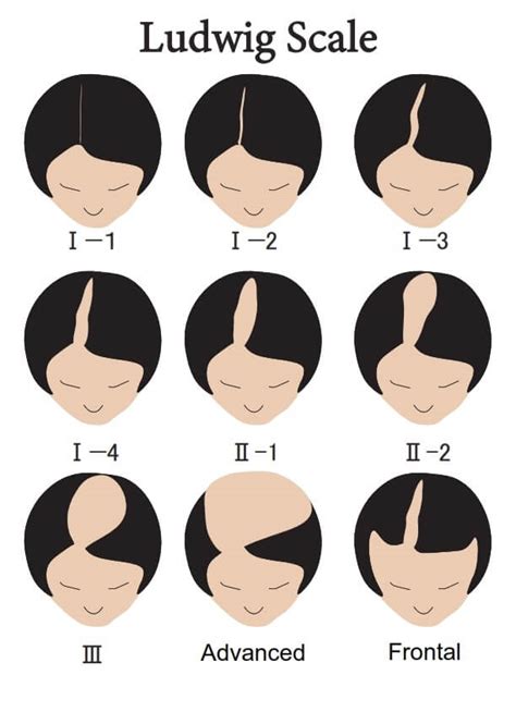 Female Pattern Hairloss Nagai Hair Restoration Academy