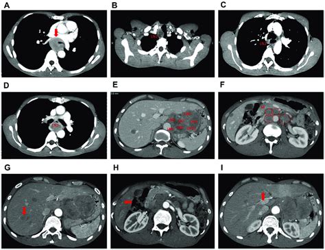 Chest And Abdominal Contrast Enhanced Ct Images At Diagnosis A