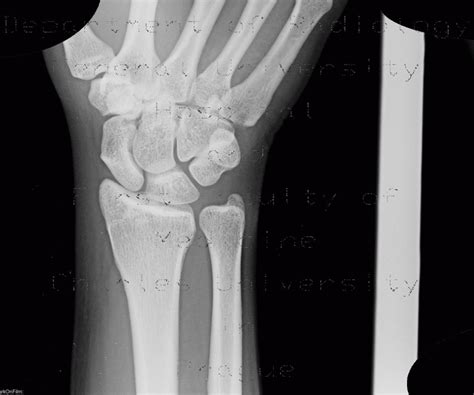 Radiology Case Wrist Normal X Ray