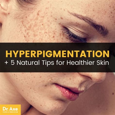 Common Causes And Treatments For Hyperpigmentation Justinboey