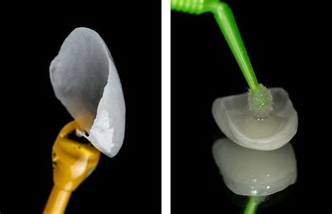 Carillas Clínica Dental Forte Clínica Dental En Cangas Moaña