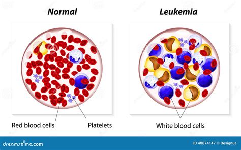 Leukemia Or Leukaemia Stock Vector Illustration Of Blood 48074147