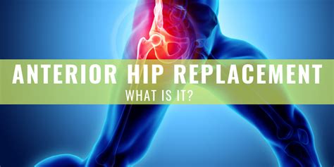 Hip Replacement Using The Anterior Approach What Is It And Why Is It