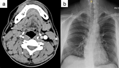 A Multiple Right Cervical Lymphadenopathies On Ct Neck B Normal Chest