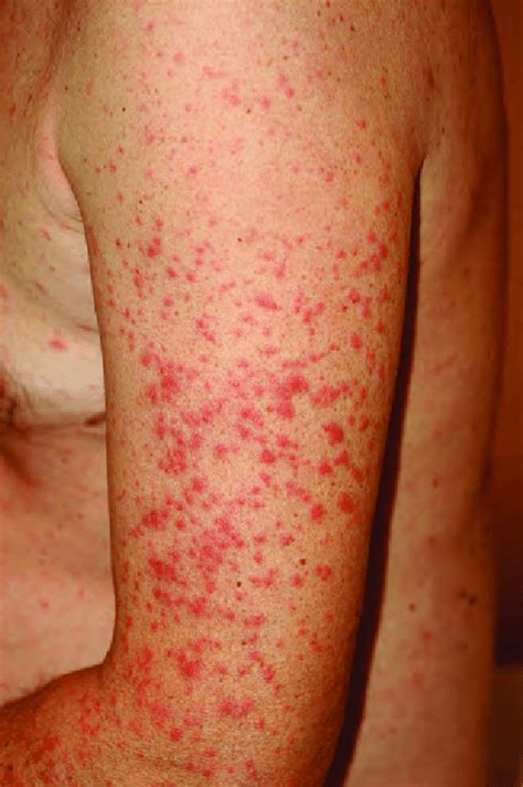Maculopapular Rash Maculae And Follicular Papules Mainly Distributed Download Scientific