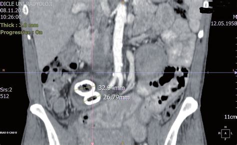 Abdominal Ct Scan Revealed Two Gallstones In The Lumen Of The Ileum