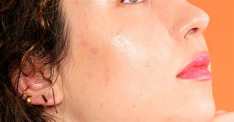 Orange Peel Skin Pores Texture Treatment