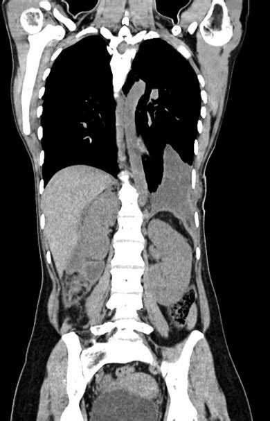 Postoperative Contrast Enhanced Computed Tomography Showing