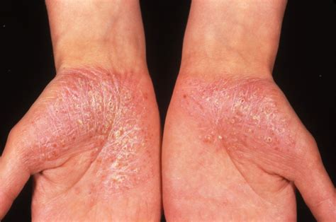 Recognizing And Managing Flares In Generalized Pustular Psoriasis