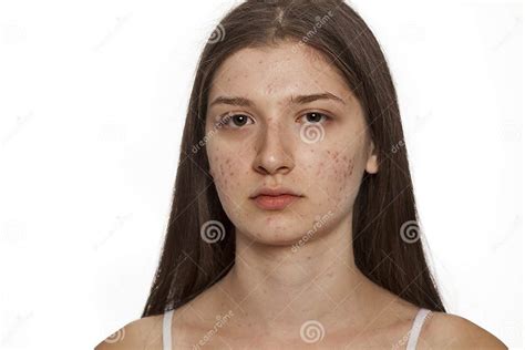 Teenage Girl With Problematic Skin Stock Image Image Of Acne Closeup