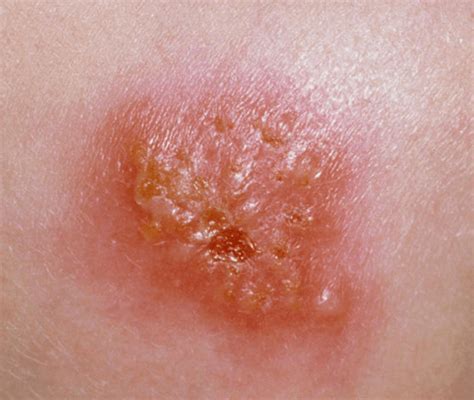Honey Crusted Skin Lesions