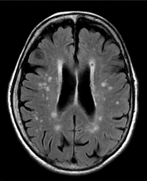 White Spots On Mri Brain Scan Images And Photos Finder