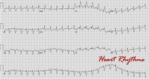 The explanation here is beyond the scope of the post, but keep in mind that most patients with atrial flutter also have (at least the tendency for) afib (see number 13.) 10. ECG Rhythms: Atrial Flutter